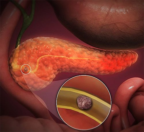 Acute Pancreatitis