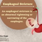 Esophageal Stricture