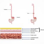 Esophageal Cancer