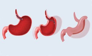 Endoscopic sleeve gastroplasty (ESG)