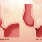 achalasia cardia, Illustration: Achalasia Cardia - Exploring the Esophageal Disorder