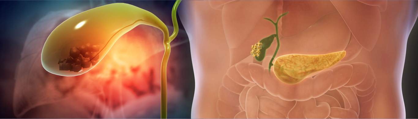 Gall Bladder Stones: Symptoms, Diagnosis, Treatment & More!